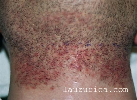 pelos encarnados en la ingle|Pelos encarnados (pseudofoliculitis)